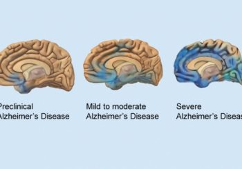 The Stages of Alzheimer’s Disease